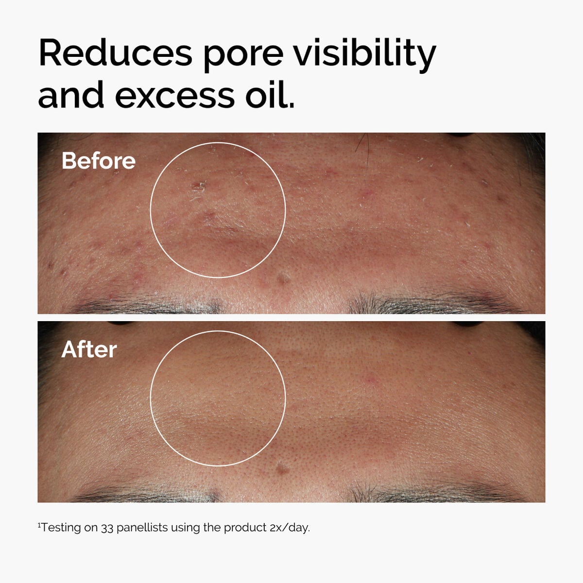 niacinamide-10-zinc-1-l2 ord-niacinamide-zinc-blemish-serum-before-after-pores.jpg