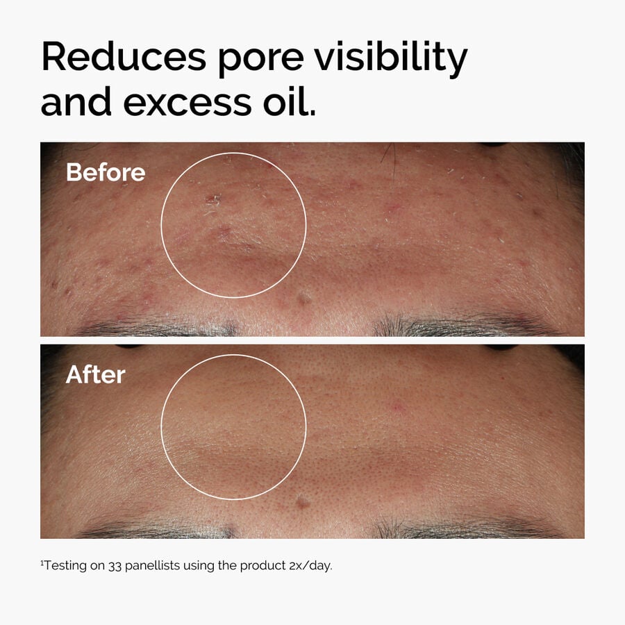 niacinamide-10-zinc-1-l2 ord-niacinamide-zinc-blemish-serum-before-after-pores.jpg