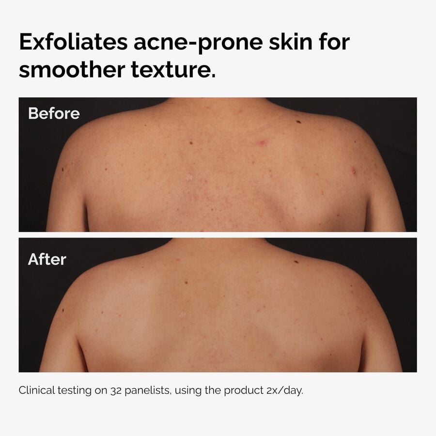 salicylic-acid-0-5-body-serum-y3 ord-salicylic-acid-body-serum-before-after-graphic-NA.jpg