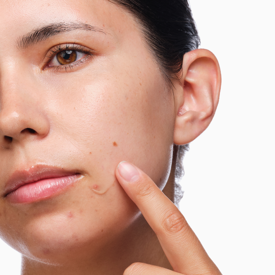 the-acne-set-q2 rdn-the-acne-set-application.png